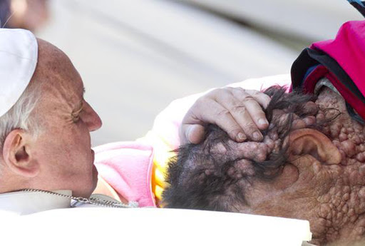 Homme défiguré bénit par le pape – es