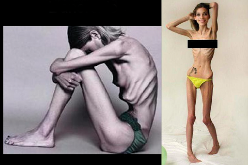 adolescenti che rifiutano il cibo (anoressia, bulimia) &#8211; es