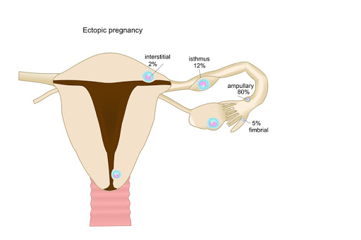 Ectopic pregnancy &#8211; es
