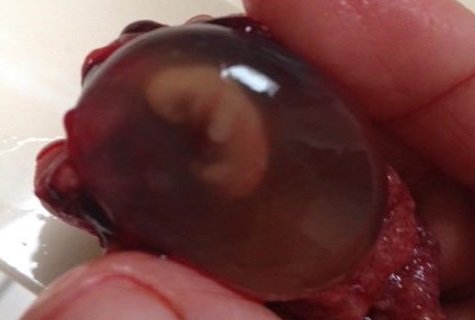 micro Subordinar Cantina Un embrión de 7 semanas producto de un aborto espontáneo