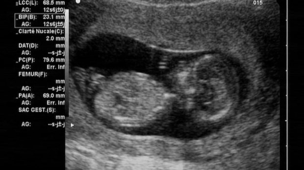 Ultrasound fetus at 12 weeks