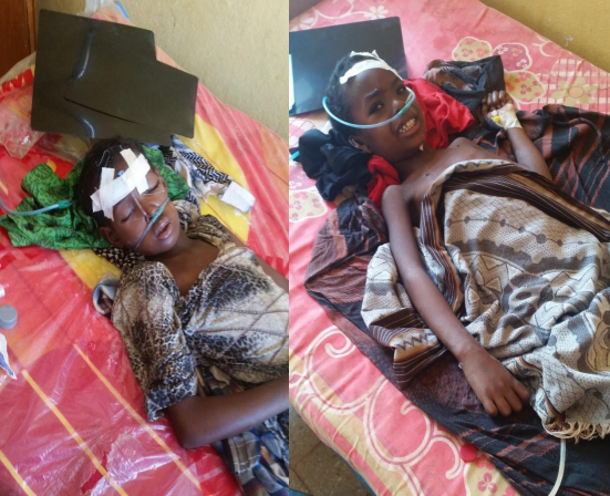 Raxxo, la niña de la izquiera y Abdi el niño de la derecha, gravemente afectados por el tifus. 