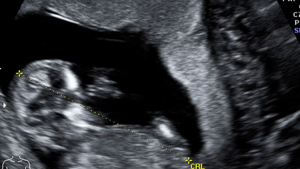 PRENATAL