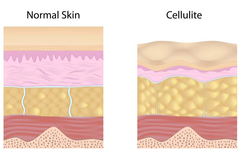 cellulite skin