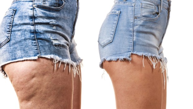 cellulite
