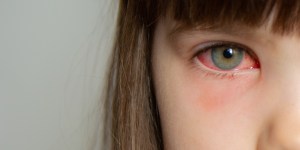 Niños y ojos rojos: la principal causa es la conjuntivitis